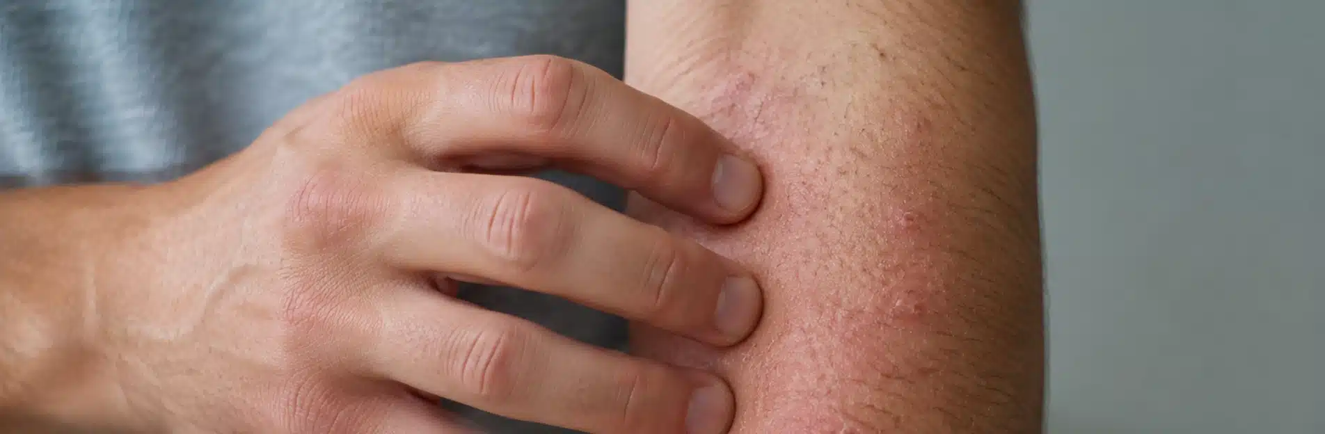 Le traitement de l'eczéma en Médecine Prophétique